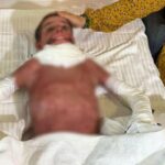 Barbekü olduğunda vücudunun yüzde 50’si yakıldı! Mustafa 11’de yapay deri nakli yapıldı.