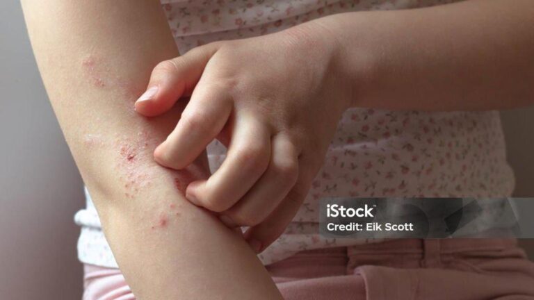 Süt alerjisinin belirtileri nelerdir? Süt alerjisi nasıl anlanır? Tedavi yöntemleri nelerdir?